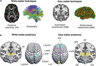 Neuroanatomical predictors of complex skill acquisition during video game training